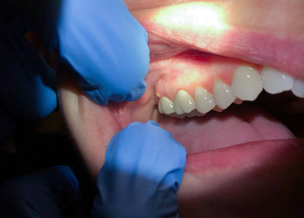Best Emergency Dentist for Knocked-Out Tooth in Lumber City, GA